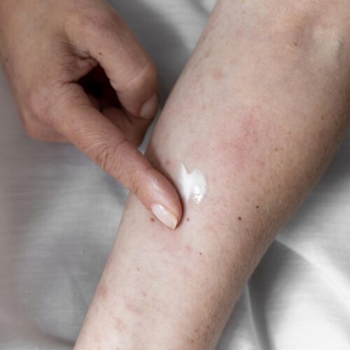 ¿Puede la avena ayudar a prevenir la dermatitis atópica en verano?
