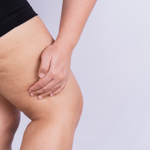 Cómo prevenir las estrías de manera efectiva